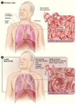 'COPD patients should have flu and pneumo vaccines' - VaccinesToday