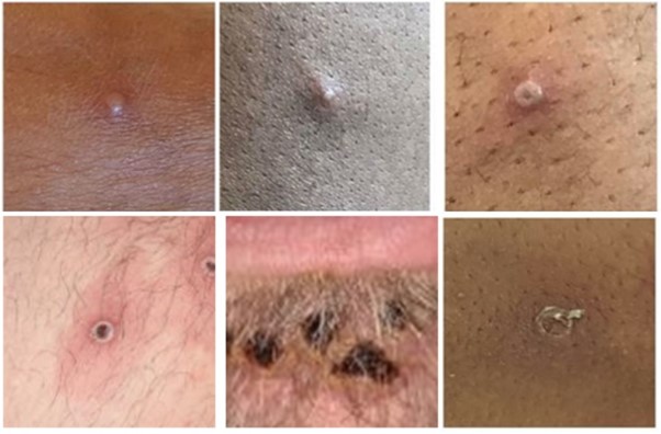 A series of six images showing stages of mpox lesion development